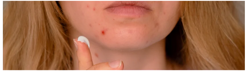 Soin Peau Acne - Parapharmacie en Ligne en Tunisie - Para Fendri